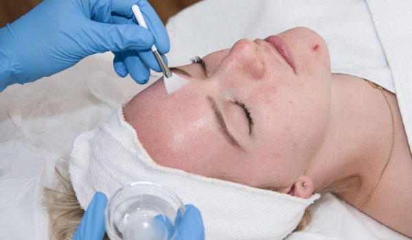 ©WirandaLund Peeling bij DermaCentrum Apeldoorn