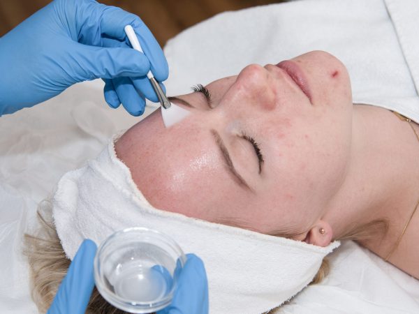 ©WirandaLund Peeling bij DermaCentrum Apeldoorn