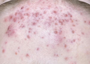 Acne