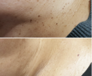 Huidoneffenheden Coagulatietherapie bij huidoneffenheden