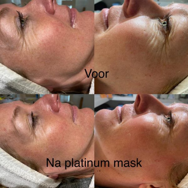 platinum-peeling-2 platinum-peeling-2