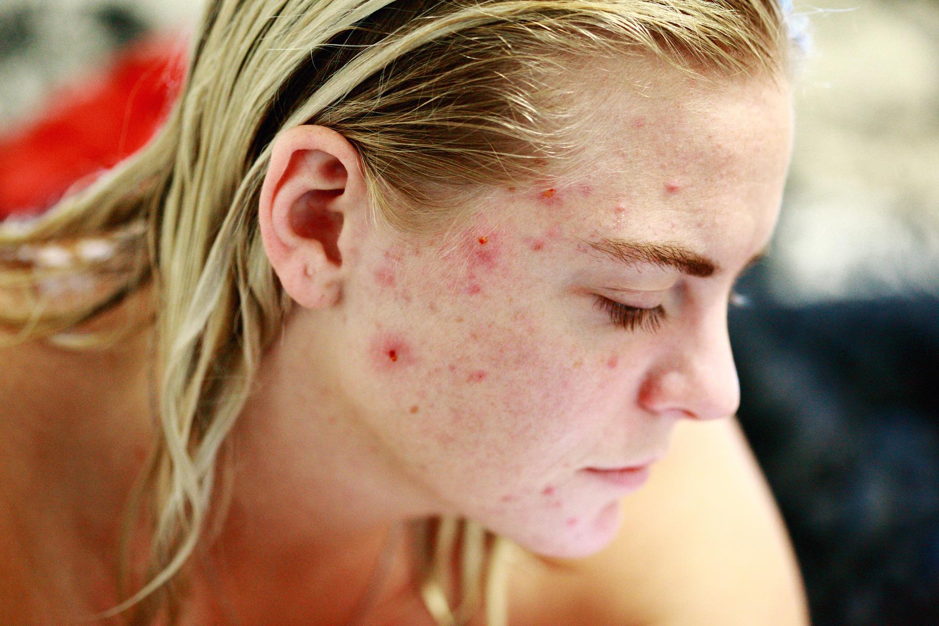 Wat kun je aan acne doen?
