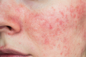 rosacea