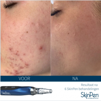 SkinPen behandeling acne littekens